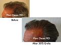 Click image for larger version

Name:	Hair Transplant Slides6.041.jpg
Views:	367
Size:	71.3 KB
ID:	463785