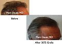 Click image for larger version

Name:	Hair Transplant Slides6.042.jpg
Views:	391
Size:	68.8 KB
ID:	463786