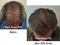 Click image for larger version

Name:	Hair Transplant Slides6.043.jpg
Views:	428
Size:	92.2 KB
ID:	463787