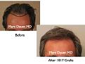 Click image for larger version

Name:	Hair Transplant Slides6.045.jpg
Views:	406
Size:	59.8 KB
ID:	463797