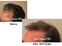 Click image for larger version

Name:	Hair Transplant Slides6.046.jpg
Views:	385
Size:	67.5 KB
ID:	463798
