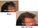 Click image for larger version

Name:	Hair Transplant Slides6.047.jpg
Views:	410
Size:	61.3 KB
ID:	463799