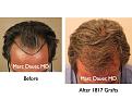 Click image for larger version

Name:	Hair Transplant Slides6.048.jpg
Views:	423
Size:	82.4 KB
ID:	463800