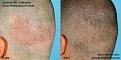 Click image for larger version

Name:	neograft_fue_donor healing_1wk.jpg
Views:	5518
Size:	20.0 KB
ID:	463849