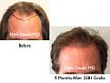 Click image for larger version

Name:	Hair Transplant Slides54.050.jpg
Views:	390
Size:	74.4 KB
ID:	463893