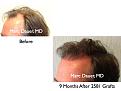 Click image for larger version

Name:	Hair Transplant Slides54.051.jpg
Views:	361
Size:	65.7 KB
ID:	463894