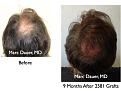 Click image for larger version

Name:	Hair Transplant Slides54.054.jpg
Views:	349
Size:	84.5 KB
ID:	463898