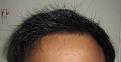 Click image for larger version

Name:	Post_HT_hairline.jpg
Views:	752
Size:	94.7 KB
ID:	464024