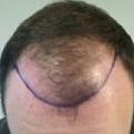 Click image for larger version

Name:	Pre op.jpg
Views:	922
Size:	23.5 KB
ID:	464309