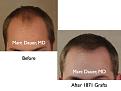 Click image for larger version

Name:	Hair Transplant Slides.065.jpg
Views:	427
Size:	51.9 KB
ID:	464483