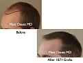 Click image for larger version

Name:	Hair Transplant Slides.066.jpg
Views:	430
Size:	49.8 KB
ID:	464484