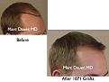 Click image for larger version

Name:	Hair Transplant Slides.067.jpg
Views:	415
Size:	56.0 KB
ID:	464485