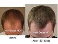 Click image for larger version

Name:	Hair Transplant Slides.068.jpg
Views:	429
Size:	69.2 KB
ID:	464486