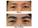 Click image for larger version

Name:	Hair Transplant Slides.071.jpg
Views:	413
Size:	60.5 KB
ID:	464487