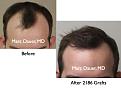 Click image for larger version

Name:	Hair Transplant Slides.085.jpg
Views:	388
Size:	55.3 KB
ID:	464519