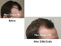 Click image for larger version

Name:	Hair Transplant Slides.086.jpg
Views:	295
Size:	49.3 KB
ID:	464520