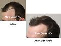 Click image for larger version

Name:	Hair Transplant Slides.087.jpg
Views:	297
Size:	50.8 KB
ID:	464521