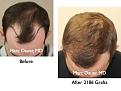 Click image for larger version

Name:	Hair Transplant Slides.088.jpg
Views:	393
Size:	73.9 KB
ID:	464522