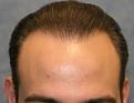 Click image for larger version

Name:	thumbs_04_after-1st-hair-transplant.jpg
Views:	323
Size:	14.8 KB
ID:	464587