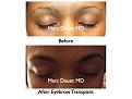Click image for larger version

Name:	Hair Transplant Slides.090.jpg
Views:	443
Size:	54.4 KB
ID:	464595