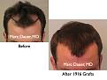 Click image for larger version

Name:	Hair Transplant Slides.091.jpg
Views:	284
Size:	58.3 KB
ID:	464598