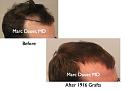 Click image for larger version

Name:	Hair Transplant Slides.092.jpg
Views:	375
Size:	56.4 KB
ID:	464599
