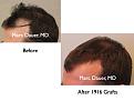 Click image for larger version

Name:	Hair Transplant Slides.093.jpg
Views:	266
Size:	53.3 KB
ID:	464600