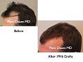 Click image for larger version

Name:	Hair Transplant Slides.093.jpg
Views:	347
Size:	53.3 KB
ID:	464600