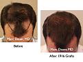 Click image for larger version

Name:	Hair Transplant Slides.094.jpg
Views:	396
Size:	66.2 KB
ID:	464601