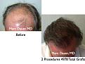 Click image for larger version

Name:	Hair Transplant Slides.097.jpg
Views:	498
Size:	75.1 KB
ID:	466206