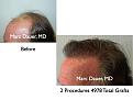 Click image for larger version

Name:	Hair Transplant Slides.096.jpg
Views:	421
Size:	63.2 KB
ID:	466207