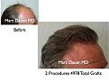 Click image for larger version

Name:	Hair Transplant Slides.095.jpg
Views:	428
Size:	66.9 KB
ID:	466208