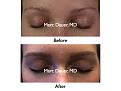Click image for larger version

Name:	Hair Transplant Slides.099.jpg
Views:	1256
Size:	53.2 KB
ID:	466219