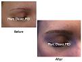 Click image for larger version

Name:	Hair Transplant Slides.100.jpg
Views:	468
Size:	47.8 KB
ID:	466220
