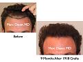 Click image for larger version

Name:	Hair Transplant Slides.102.jpg
Views:	451
Size:	63.4 KB
ID:	466401