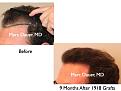 Click image for larger version

Name:	Hair Transplant Slides.103.jpg
Views:	375
Size:	57.3 KB
ID:	466402