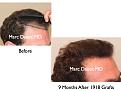 Click image for larger version

Name:	Hair Transplant Slides.104.jpg
Views:	370
Size:	62.7 KB
ID:	466403
