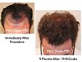 Click image for larger version

Name:	Hair Transplant Slides.105.jpg
Views:	428
Size:	79.7 KB
ID:	466404