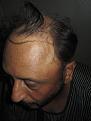 Click image for larger version

Name:	Darling Buds Hair Transplant @Chandigarh (3).jpg
Views:	656
Size:	91.6 KB
ID:	466413