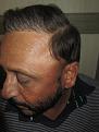 Click image for larger version

Name:	Darling Buds Hair Transplant @Chandigarh (1).jpg
Views:	1238
Size:	93.9 KB
ID:	466414