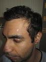 Click image for larger version

Name:	Darling Buds Hair Transplant @ Chandigarh, India (1).JPG
Views:	1050
Size:	47.4 KB
ID:	466421