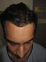 Click image for larger version

Name:	Darling Buds Hair Transplant @ Chandigarh, India (2).JPG
Views:	869
Size:	42.9 KB
ID:	466422