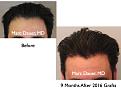 Click image for larger version

Name:	Hair Transplant Slides.110.jpg
Views:	445
Size:	56.1 KB
ID:	466464