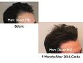 Click image for larger version

Name:	Hair Transplant Slides.109.jpg
Views:	433
Size:	50.7 KB
ID:	466465