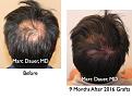 Click image for larger version

Name:	Hair Transplant Slides.107.jpg
Views:	564
Size:	85.4 KB
ID:	466467