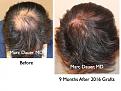 Click image for larger version

Name:	Hair Transplant Slides.106.jpg
Views:	548
Size:	91.8 KB
ID:	466468