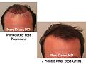 Click image for larger version

Name:	Hair Transplant Slides.117.jpg
Views:	347
Size:	63.4 KB
ID:	466487