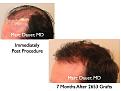 Click image for larger version

Name:	Hair Transplant Slides.118.jpg
Views:	370
Size:	60.4 KB
ID:	466488