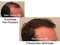 Click image for larger version

Name:	Hair Transplant Slides.119.jpg
Views:	341
Size:	65.6 KB
ID:	466489