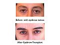 Click image for larger version

Name:	Hair Transplant Slides eyebrows.120.jpg
Views:	532
Size:	54.3 KB
ID:	466491